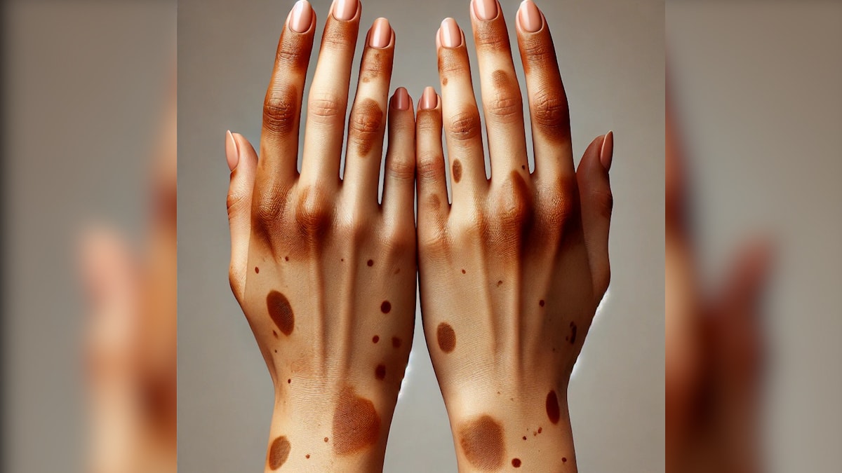 Ellerde kahverengi lekeler neden oluşur?