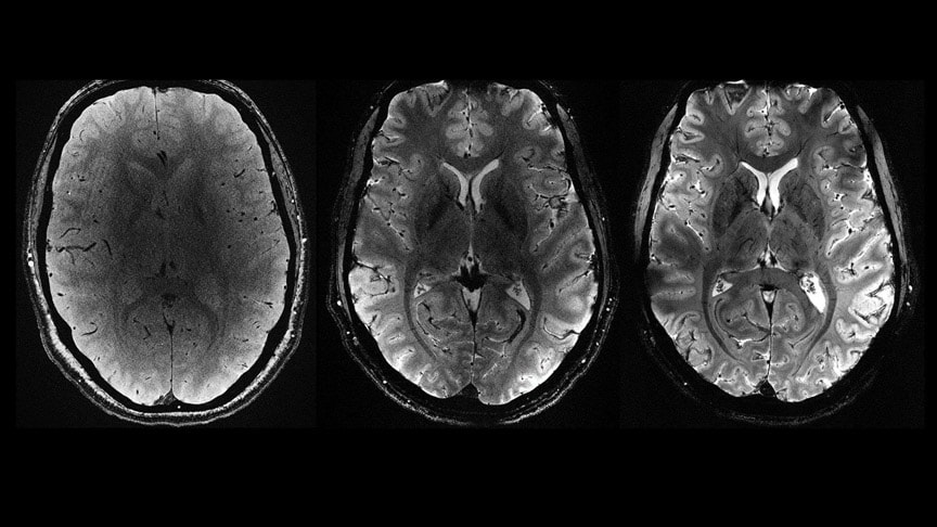 Çarpıcı araştırma: Hafif sarsıntı bile beyne zararlı