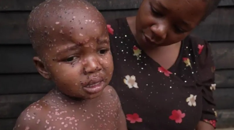 Maymun çiçeğinde acı tablo: Çoğu çocuk