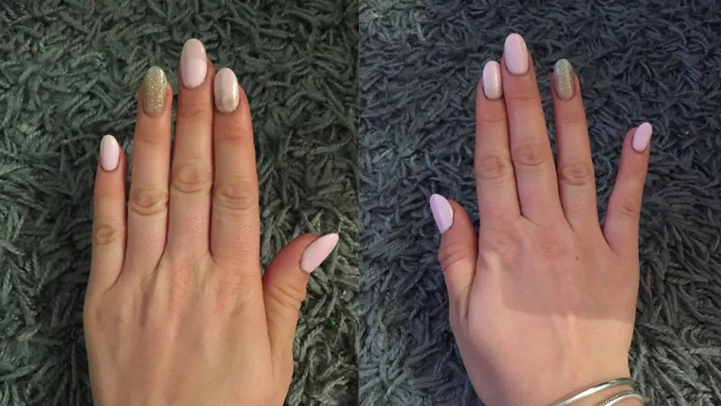 Telefonu tek elle tutanlar dikkat! “Smartphone Pinky” olabilirsiniz…