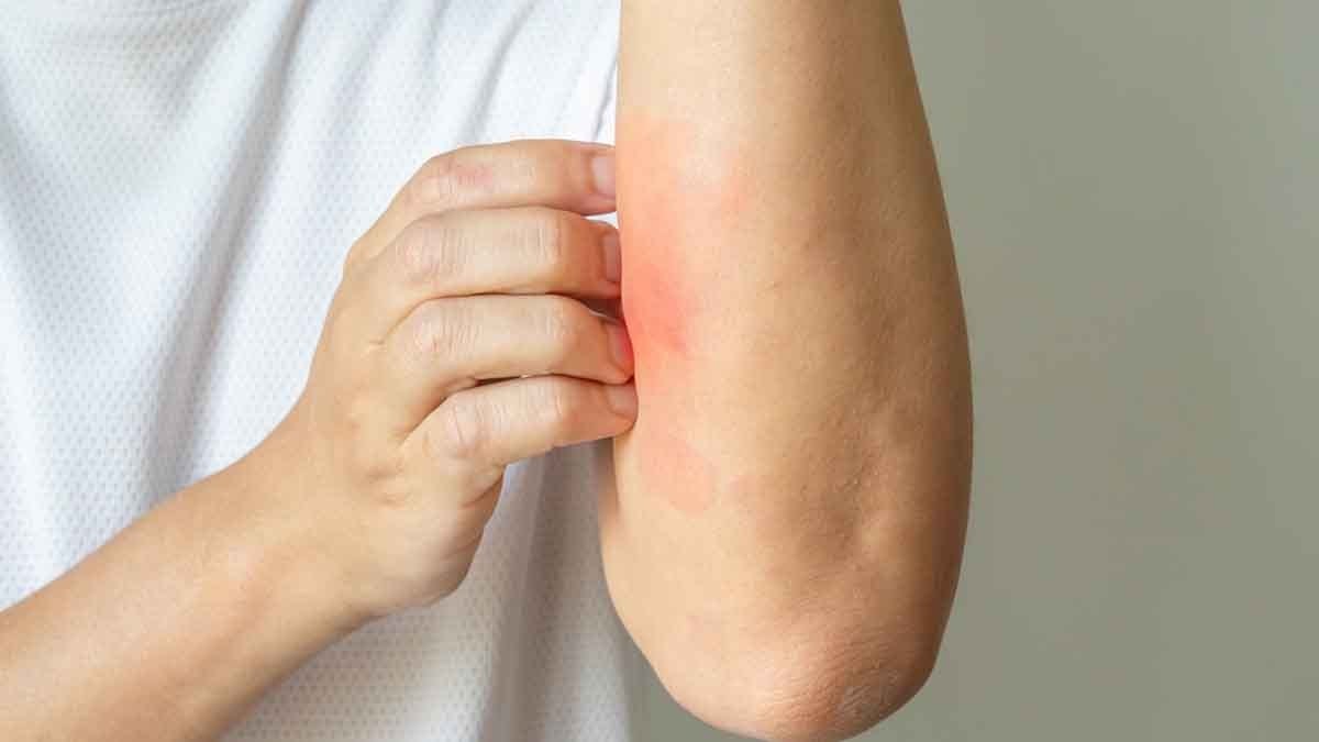 Kaşınmak aslında sağlığa çok faydalıymış: Pittsburgh Üniversitesi araştırdı! İşte sağladığı fayda…