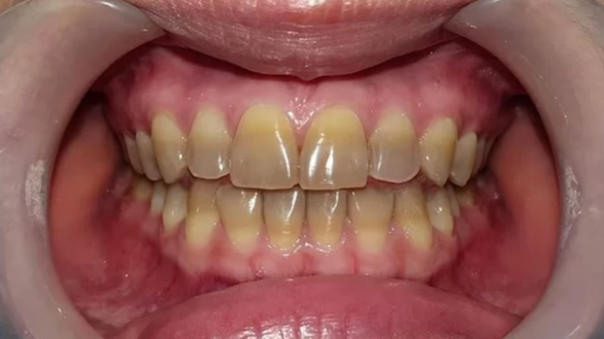 Dişinizin rengi hastalığınızı ortaya çıkarıyor