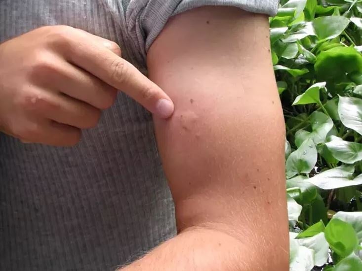 Sivrisineklerde virüs alarmı: 10 kişiden biri ölüyor