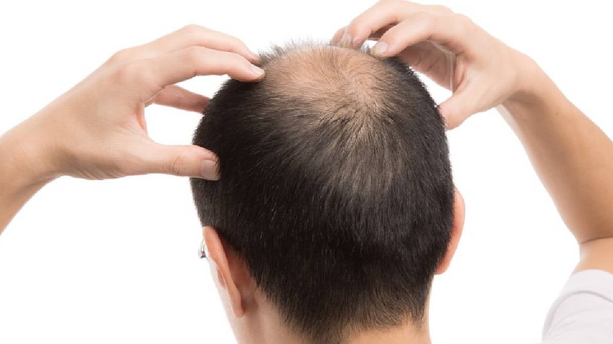 Saç dökülmesini engelliyor kellik tarihe karışıyor